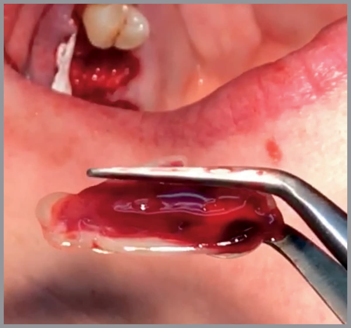 Salvin Membrane / PRF Forceps With “Peanut” Shaped Tip - Left